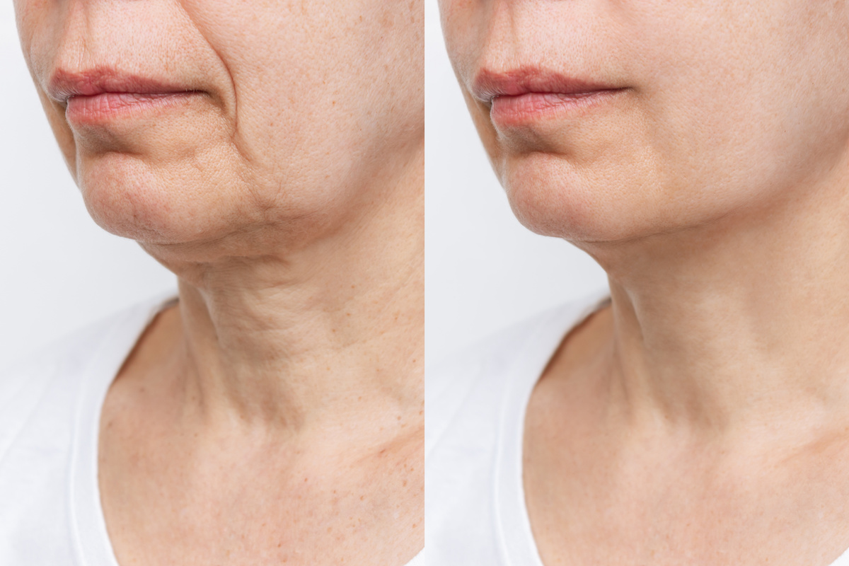 Lower part of the face and neck of elderly woman with signs of skin aging before and after facelift, plastic surgery on white background. Rejuvenation of flabby sagging skin, wrinkles, creases